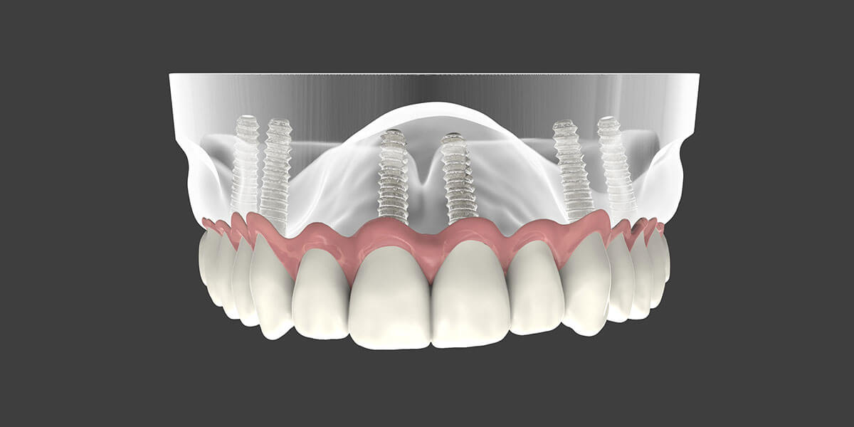 Implant Supported Dentures